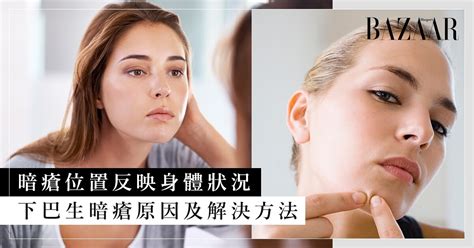 下巴生暗瘡解決方法|為何額頭、下巴經常生暗瘡？教你6個方法根據暗瘡位。